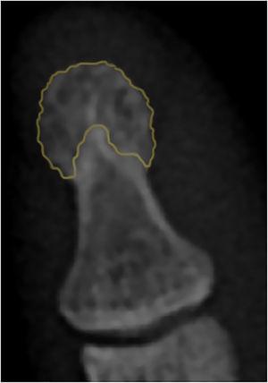 Apariencia radiográfica usual del penacho. El color naranja demarca el área correspondiente al PFDM. Denote la típica apariencia lanceolada (en lóbulos) de la cortical.