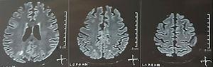 Resonancia magnética nuclear de cerebro simple + difusión de control (3 semanas después): lesiones previas en resolución.
