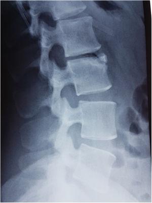 laterale röntgenfoto van de lumbale wervelkolom met een driehoekig beeld op het voorpand van L3.