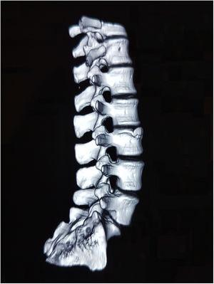 tomografie axială computerizată a coloanei lombare cu reconstrucție 3D care indică o neregularitate osoasă anterosuperioară în L3 care nu se separă de corpul vertebral.