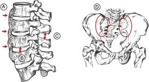Criterios radiológicos de Resnick-Niwayama: A: osificación del ligamento longitudinal anterior en mínimo 4 vértebras contiguas; B: preservación del espacio intervertebral; C: preservación de la articulación facetaria; D: ausencia de afectación de la articulación sacroilíaca.