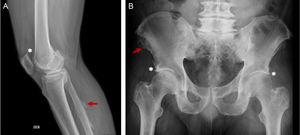 Varón de 65 años, obeso, con cuadro de 15 años de evolución de dolor en columna dorso-lumbar y rodillas asociado a parestesias en miembro inferior derecho. Hallazgos en la radiografía (A) rodilla derecha, excrecencias óseas en patela (*) y en entesis fíbula (flecha roja), (B) osificación en entesis de las espinas ilíacas (flecha roja) y acetábulo (*).