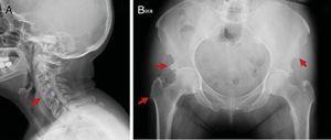 Mujer de 71 años, diabética, con cuadro clínico de 4 años de evolución de dolor y limitación cérvico-dorsal. Hallazgos en la radiografía (A) cervical, puentes óseos C2-C7 (flecha roja), (B) pélvica, excrecencias óseas en entesis de espina ilíaca, acetábulo y trocánter mayor de fémur (flecha roja).