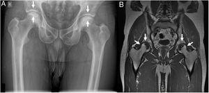 Bilateral avascular necrosis of the femoral heads in a patient with systemic lupus erythematosus. Panel A shows a pelvic posterior-anterior radiography where subchondral sclerosis is evident at the femoral heads, bilaterally (white arrows). No insufficiency fractures are seen and articular space is preserved in both joints. This X-ray would correspond to a grade 2 according to Arlet and Ficat's classification. Panel B shows a pelvic magnetic resonance imaging T1 coronal cut with crescentic areas of T1 hypointensity (white arrows) consistent with avascular necrosis involving two thirds of the articular surface bilaterally. There are no insufficiency fractures. This second technique shows a grade 3 AVN as per Arlet and Ficat.