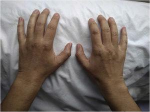Imagen de las manos de la paciente en el momento de la primera consulta ambulatoria con reumatología. Se evidencia edema de ambas muñecas, de las 5 metacarpofalángicas, así como de las interfalángicas proximales bilaterales de los dedos segundo, tercero, cuarto y quinto.