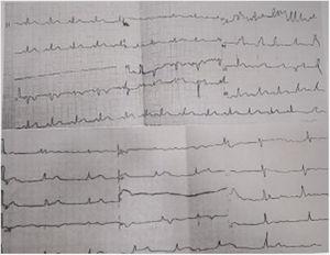 Electrocardiogramas inicial y control. Electrocardiograma inicial normal (imagen superior), electrocardiograma control con bradicardia sinusal (imagen inferior).