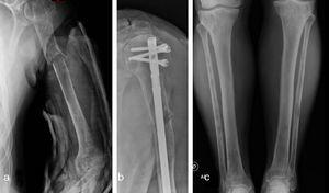 Radiografías simples: a) fractura patológica en húmero izquierdo, diafisiaria; b) fractura de húmero fijada con un clavo endomedular; c) lesiones líticas y osteoesclerosas en tibia y peroné bilaterales.