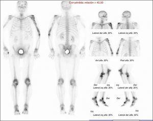 Gammagrafía ósea con Tc-99: importante captación en húmero proximal y diafisiaria izquierda y tibias proximales.