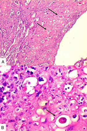 La presencia de células escamosas grandes con extenso citoplasma, pleoformismo nuclear y en su mayoría aumentado e infiltrado