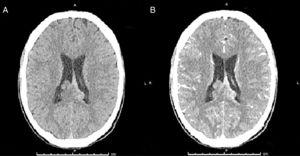 Tomografía cerebral, cortes axiales: A. TAC cerebral simple B. TAC cerebral contrastada. Se observa lesión expansiva que compromete el cuerpo calloso, septum pellucidum en zona posterior, con extensión al epéndimo y cuerpos ventriculares con realcenodular en las lesiones interventriculares, bilaterales.