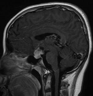 Sagittal T1+MC brain MRI shows a sellar mass with suprasellar extension, lobulated, with a solid and cystic component, which is intensely highlighted by the contrast media. This lesion was not seen in previous studies.