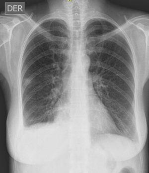 Radiografía de tórax PA que evidencia silueta cardiaca normal y obliteración de receso costofrénico lateral y posterior derecho.