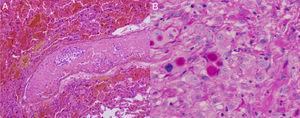 A y B. Se evidencian infartos pulmonares en varios estadios de evolución y la presencia de microtrombos murales. Pleura diafragmática con compromiso por adenocarcinoma metastásico.
