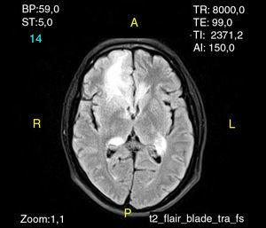 Imagen por resonancia magnética (IRM) simple de cerebro del caso 1. Corte axial en T2 que muestra hiperintensidad de la sustancia blanca frontal bilateral, del rostro del cuerpo calloso y ambos núcleos caudados, además signos de edema.