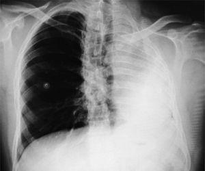 Radiografía de tórax en la que se observan la tráquea y el mediastino con notable desviación hacia la izquierda, opacidad total del campo pulmonar izquierdo y hernia del pulmón derecho hacia la izquierda.