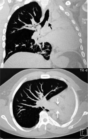 El corazón y los grandes vasos se encuentran ocupando el hemitórax izquierdo. Ausencia de bronquio principal izquierdo (flecha negra), ausencia de arteria pulmonar izquierda (flechas blancas).