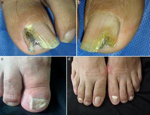 Onychomycosis in the elderly. A 2-year retrospective study of 138 cases ...