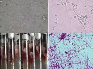 (a) Filamentous fungi or arthroconidia (10% KOH, 40×). (b) Pseudohyphae and blastoconidia (10% KOH, 40×). (c) Culture of Trichophyton rubrum in SDA. (d) Microaleurioconidia of Trichophyton rubrum (2% erythrosine 40×)