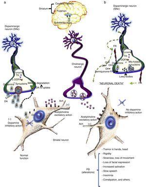 Current treatments in Parkinson's including the proposal of an ...