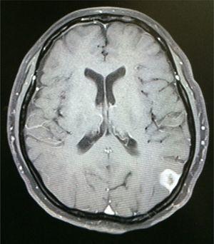 RM T1-contrasto: taglio assiale, lesione corticale parietale sinistra osservata con notevole edema perilesionale verso il lobo temporale ipsilaterale, un pattern di miglioramento del mezzo di contrasto eterogeneo, simile a popcorn e aree ipointense all'interno della lesione.