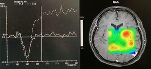 Sequenza di spettroscopia che mostra livelli marcatamente aumentati di lattato e lipidi e un lieve aumento della colina.