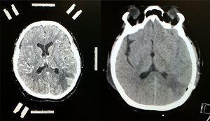 Contraste tomografia computadorizada de o lado esquerdo do cérebro, mostrando estereotaxia quadro e fiduciais; meio de contraste realce da região parietal esquerda mostrando lesão tumoral com grande edema perilesional. Uma tomografia do lado direito do cérebro, sem contraste, mostra uma ressecção total da lesão com imagem hipodense que denota gliose no lobo parietal esquerdo.