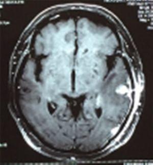 MRI T1-contrast: axiale snede met een nieuwe, recidiverende corticale laesie met harde implantatie in de linker temporale kwab, versterking van homogeen contrastmedium en gevaarlijk oedeem.