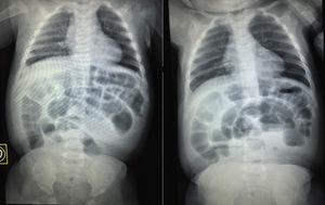 Rail simple de raias de abdome e decubitus que mostran unha mala distribución de aire, distensión de o intestino delgado e colon, a ausencia de aire en brecha pélvica, fluídos e niveis de gas.