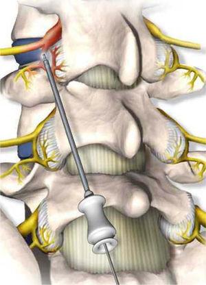 The electrodes must be inserted obliquely from low to high and the tip must be located in the central two quarters of the articular process. Image with electrocauterisation electrode, with lesion in the posterior sensory root.