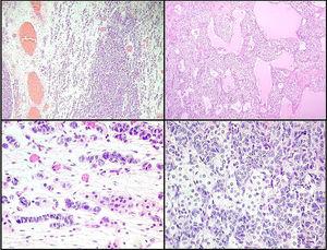 Left ovarian tumour (first tumour). A. Solid lobular areas are observed, alternating with hypocellular areas of lax stroma with trabecular and linear formations. B. Structures with a tubular appearance and cystic areas containing homogeneous eosinophilic material are identified between solid areas. C and D. Sertoli cells arranged in a trabecular pattern. Areas of Leydig cells with a central nucleus, a single nucleolus and eosinophilic to clear cytoplasm are observed.