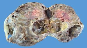 Right ovarian tumour. Lesion of 23.5×18.8×7.5cm weighing 500g, with a smooth, bright, intact capsule, a heterogeneous cut surface, solid brown areas occupying approximately 70% of the lesion and cystic areas occupying the remaining 30%.