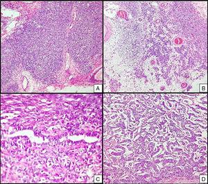 Right ovarian tumour. Microphotographs are observed with multiple patterns in the same tumour: A. Solid poorly differentiated sarcomatoid areas consisting of short fusiform cells with randomly organised hyperchromatic ovoid nuclei. B. Areas with a more classic appearance of a Sertoli–Leydig cell tumour, with solid areas and areas of Sertoli cell trabeculae interconnected with each other alternating with areas of dispersed cell groups on a lax background. C. Tubular areas similar to those observed on the left ovarian tumour, arranged in a dispersed fashion, with some between the sarcomatoid areas and D. areas with a trabecular–gyriform pattern.