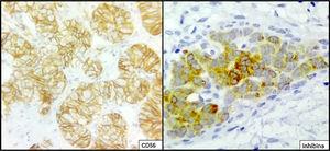 Microphotographs from an immunohistochemistry study with an immunoperoxidase technique performed on the right ovarian tumour showing positivity for anti-CD56 antibody in membrane in tumour cells, and cytoplasmic and membrane positivity for anti-inhibin antibody in tumour cells.