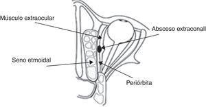 Este esquema muestra que se ha coleccionado pus en el espacio extraconal, entre la periórbita y los músculos extraoculares; además se ve edema del seno etmoidal.