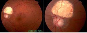 Retina de OI, lesión tumoral peripapilar.