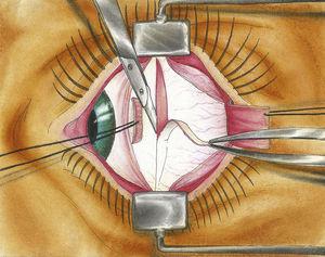Técnica de resección escleral lamelar: se resecaba una porción de esclera para acortar el globo ocular por fuera y producir efecto indentador por dentro.
