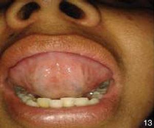 Úlceras en lengua remitidas.