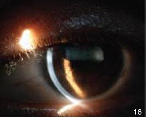 Segmento anterior de ojo izquierdo postratamiento.
