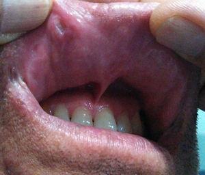 Úlceras orales.