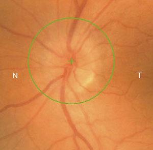Nervio óptico del ojo izquierdo con edema.