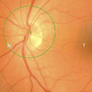 Nervio óptico del ojo izquierdo de una semana de evolución con disminución del edema.