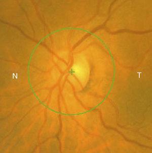 Nervio óptico del ojo izquierdo con relación excavación/papila de 0.3.