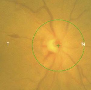 Nervio óptico del ojo derecho de un día de evolución con disminución de las hemorragias en llama pero persistencia del edema.