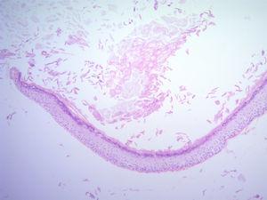 Corte histológico: pared del quiste con células de la epidermis.