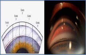 Comparación de la gradación del ángulo iridocorneal según Schaffer, con el ángulo iridocorneal de nuestra paciente, donde se aprecian todas las estructuras vistas en su grado iv.