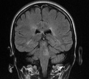 Multiple hyperintense lesions on Fluid Attenuated Inversion Recovery (FLAIR) imaging in the pons, besides periventricular, subcortical and infratentorial lesions in both hemispheres.