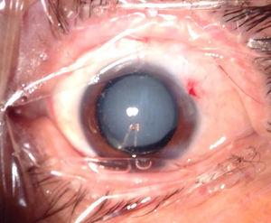 Condensación de lente intraocular dentro del globo ocular.