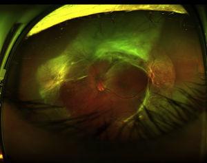 Fotografía de campo ultra-amplio en un ojo izquierdo obtenida con un Optos Daytona (Optos, Dunfermline, Reino Unido) que muestra un desprendimiento de retina traccional en el ojo izquierdo, secundario a retinopatía diabética proliferativa.