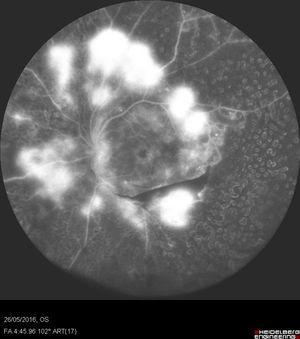 Angiografía con fluoresceína de 102 grados obtenida con el Heidelberg Spectralis (Heidelberg Engineering, Heidelberg, Alemania), en la que se muestra una intensa actividad neovascular y edema macular angiográfico. Puede observarse que a pesar de que el ojo ha sido tratado con fotocoagulación, hay amplias áreas de cierre capilar que no han sido tratadas adecuadamente.