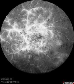 Angiografía con fluoresceína de 102 grados obtenida con el Heidelberg Spectralis (Heidelberg Engineering, Heidelberg, Alemania), en la que se muestra una oclusión de la vena central de la retina no isquémica, con abundante fuga por incompetencia vascular.